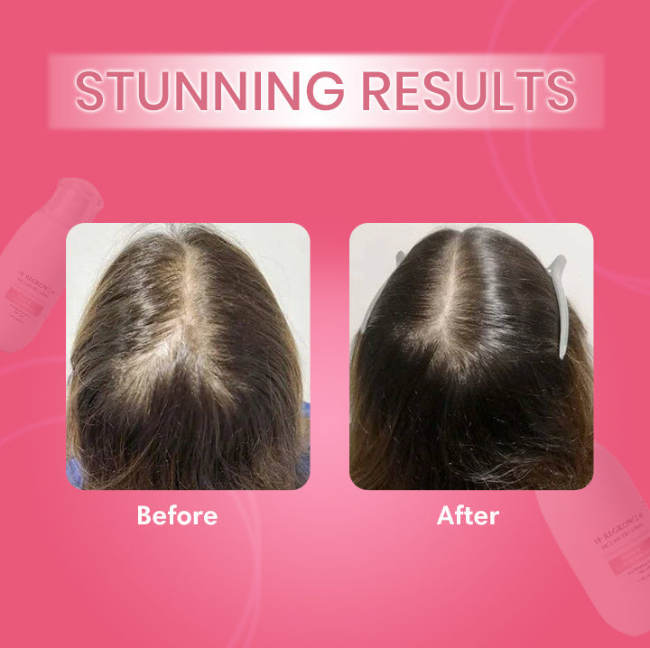 Hair-Regrowth Spray 2.0